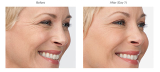 Botox Injections Manhattan Injectable Dermal Fillers Nyc - 